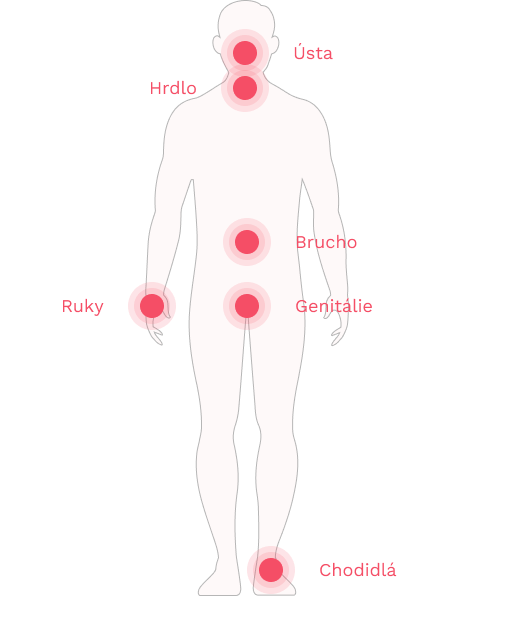 Obrázok symptómov HAE
